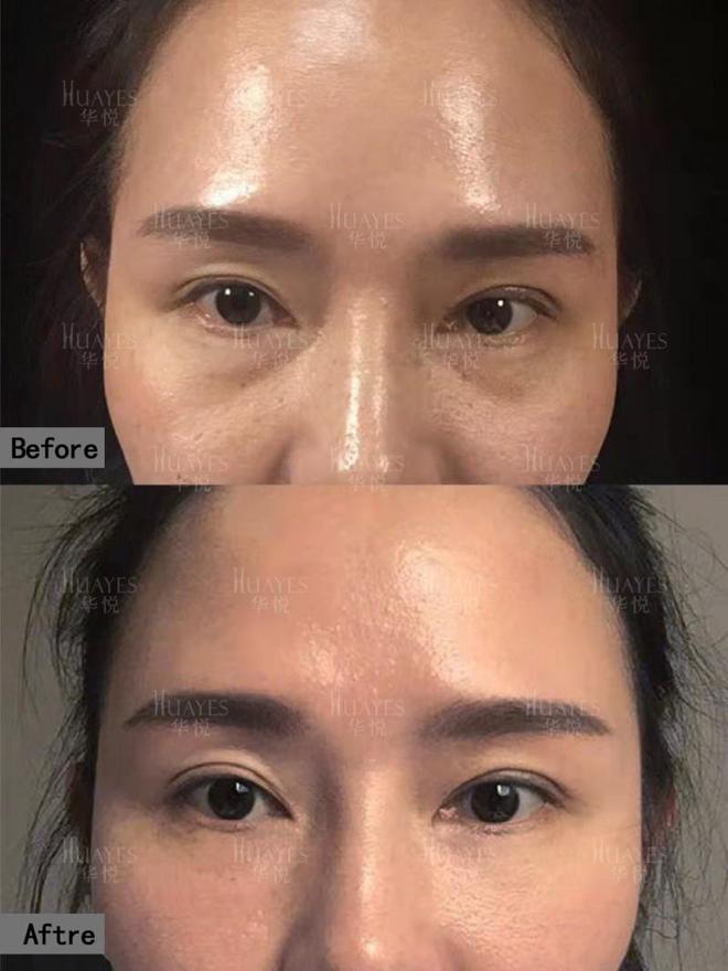 ：重塑眼部青春光彩一键重启眼部青春魅力j9九游会(中国)网站华悦白孝梅院长