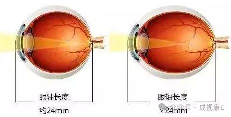视人群这几条内容务必知道！九游会【爱眼小课堂】高度近(图1)